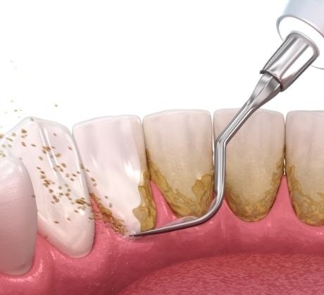 Dr. Robert Madry. Rob Madry DDS. General Dentist, Cosmetic Dentist, Restorative Dentist, Preventative Dentist, Family Dentist. Veneers, Teeth Whitening, Same-Day Crowns, Invisalign, Smile Makeover, Implant Restoration. Dentist in Corpus Christi, TX 78411