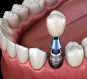 Dr. Robert Madry. Rob Madry DDS. General Dentist, Cosmetic Dentist, Restorative Dentist, Preventative Dentist, Family Dentist. Veneers, Teeth Whitening, Same-Day Crowns, Invisalign, Smile Makeover, Implant Restoration. Dentist in Corpus Christi, TX 78411