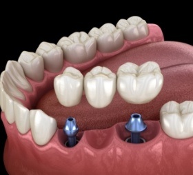 Dr. Robert Madry. Rob Madry DDS. General Dentist, Cosmetic Dentist, Restorative Dentist, Preventative Dentist, Family Dentist. Veneers, Teeth Whitening, Same-Day Crowns, Invisalign, Smile Makeover, Implant Restoration. Dentist in Corpus Christi, TX 78411
