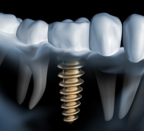 Dr. Robert Madry. Rob Madry DDS. General Dentist, Cosmetic Dentist, Restorative Dentist, Preventative Dentist, Family Dentist. Veneers, Teeth Whitening, Same-Day Crowns, Invisalign, Smile Makeover, Implant Restoration. Dentist in Corpus Christi, TX 78411