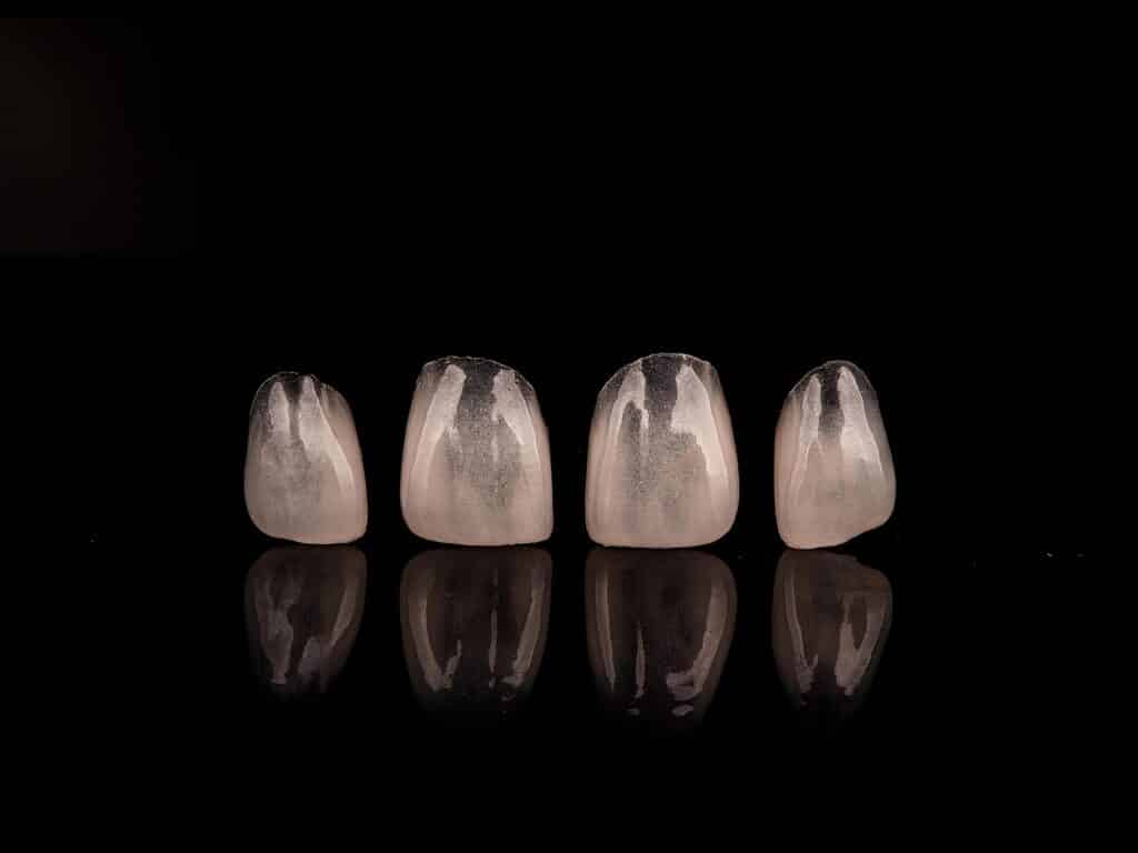 dental veneers Corpus Christi