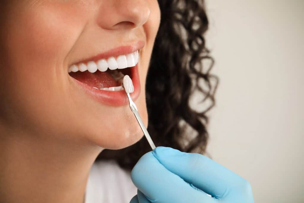 dental veneers Corpus Christi