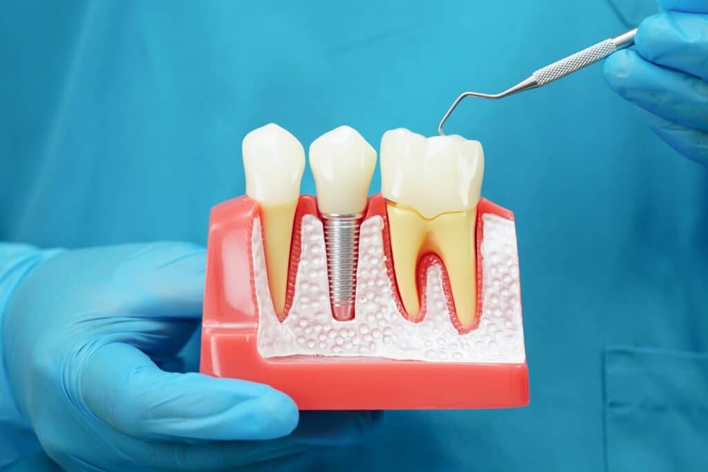 dental implant restoration near me