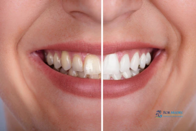 Smile makeover options showing before and after cosmetic dental treatment