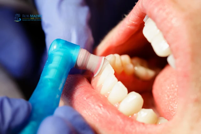 Dental cleaning benefits at Rob Madry DDS