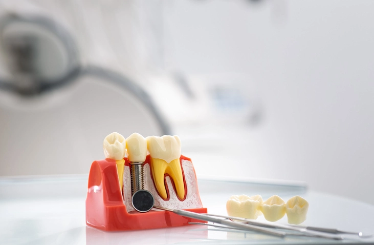 Dental implant restorations